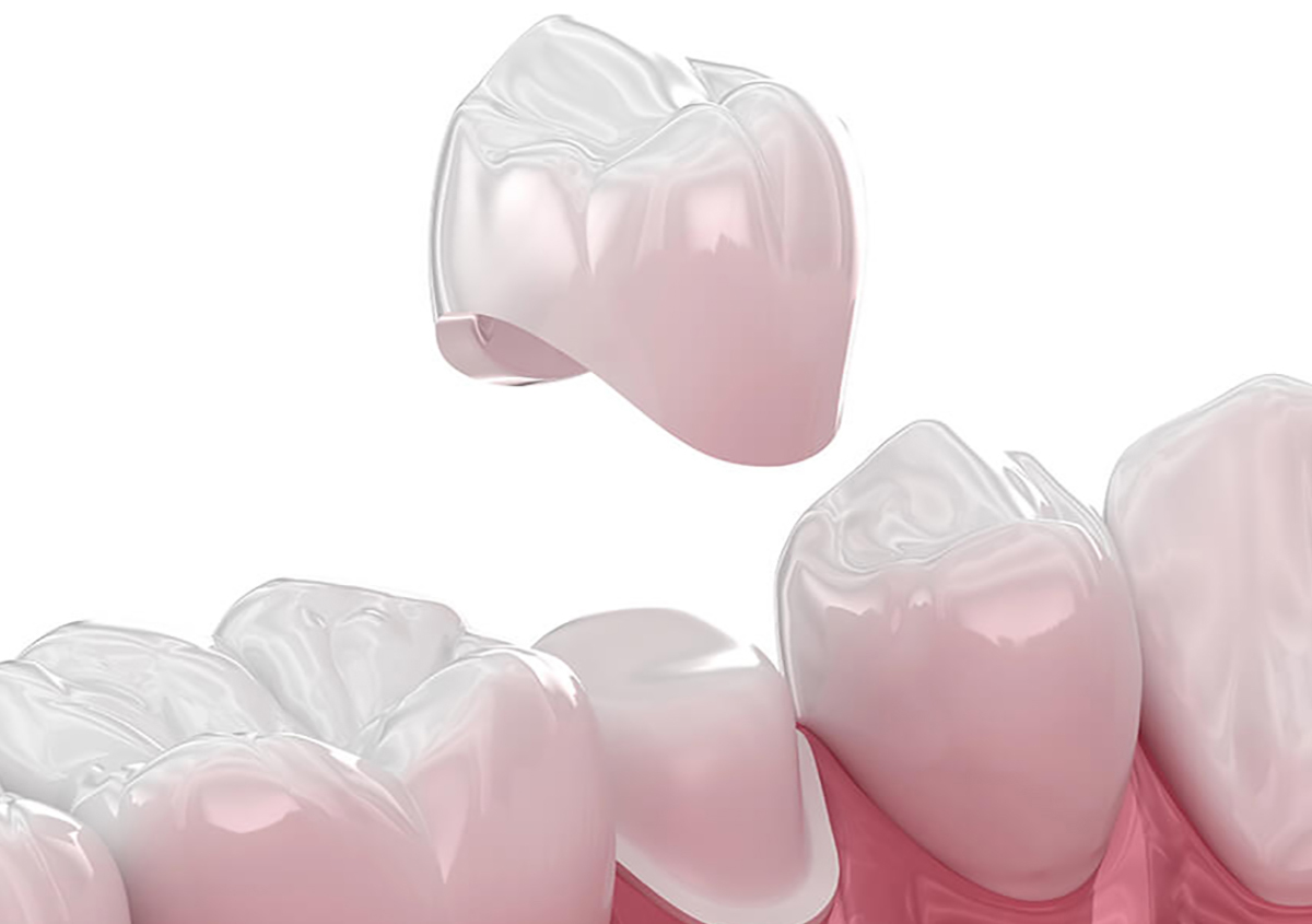 Crowns for Your Teeth in Prescott WI Area