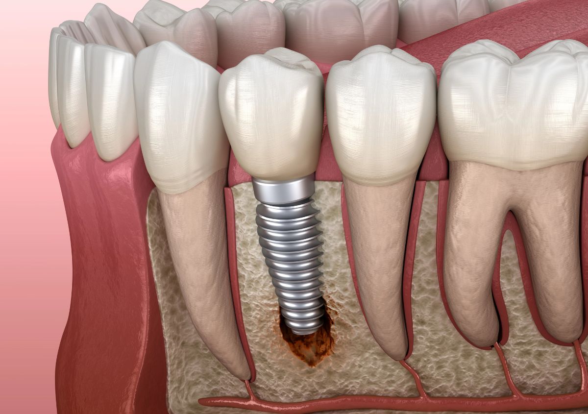 Peace of Mind and a Confident Smile: 5 Ways Dentists Keep Dental Implants Safe for Seniors